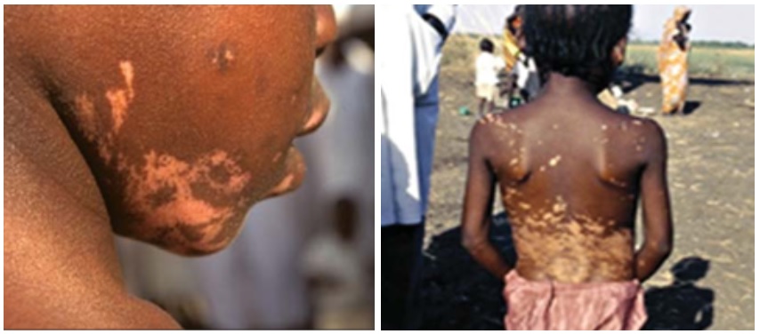 Imágenes de dos menores afectados de diferentes grados de leishmaniasis PKDL (Fotos: Organización Mundial de la Salud).